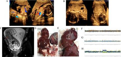 Case report: Fetal cervical immature teratoma and copy number variations